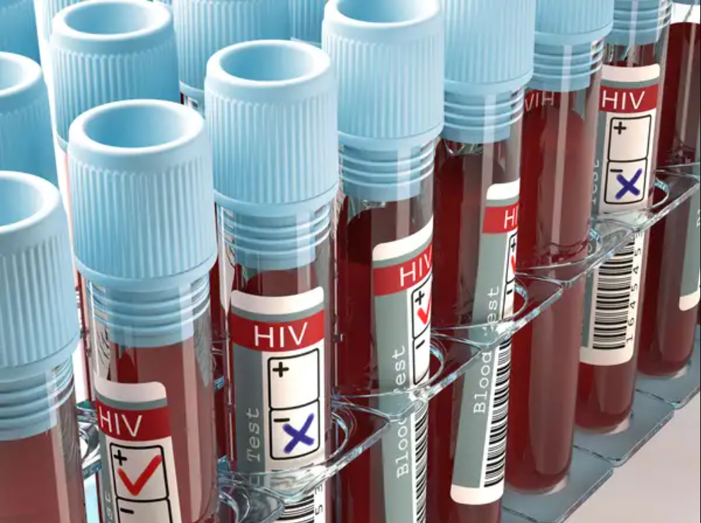 Alberta health reports reveals rising HIV rates