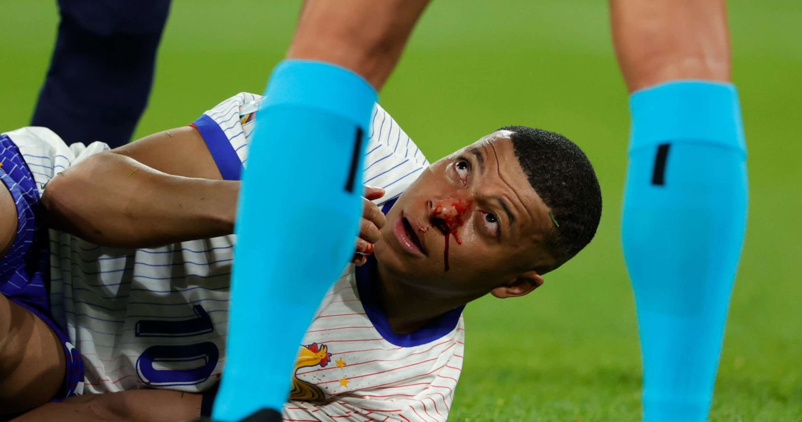 France’s Kylian Mbappé Avoids Surgery For Broken Nose Injury vs. Austria; Status TBD