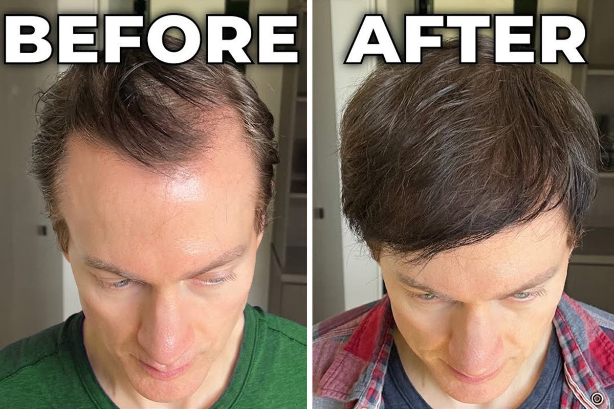 Millionaire biohacker Bryan Johnson reveals how he reversed hair loss and greying