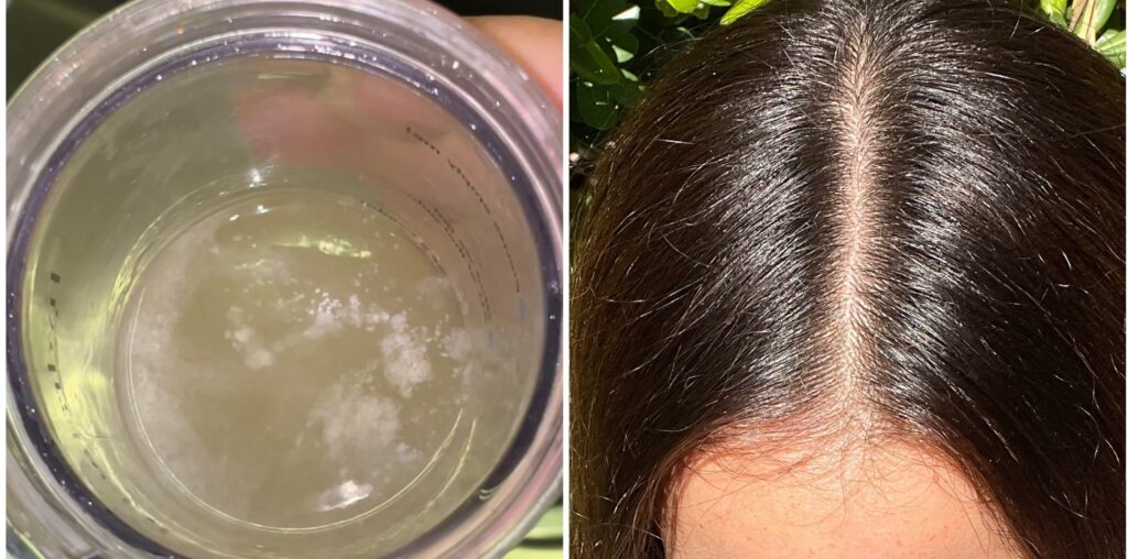 My Scalp Was Itchy and Dry Until I Tried a Scalp "Detox"